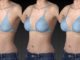 The Quality of Breast Augmentation Is The Best Ever in 2019