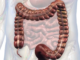 Peritoneal Cancer: What you need to know?