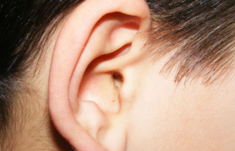 What is Glue Ear?