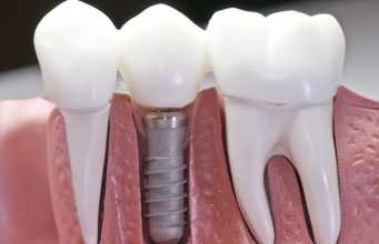 The Journey to a New Smile: Your Guide to Dental Implant Treatment
